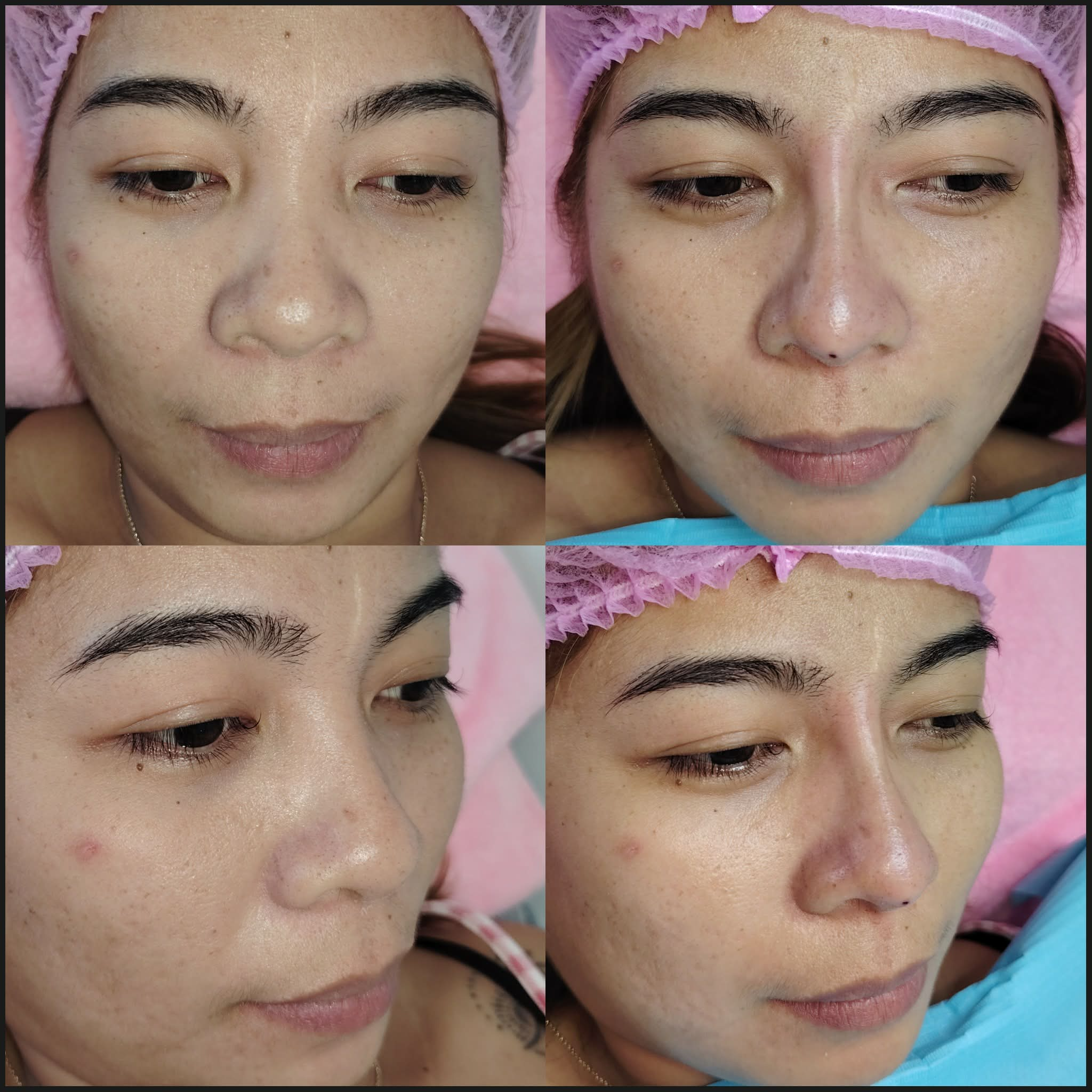 Jaw slimming result